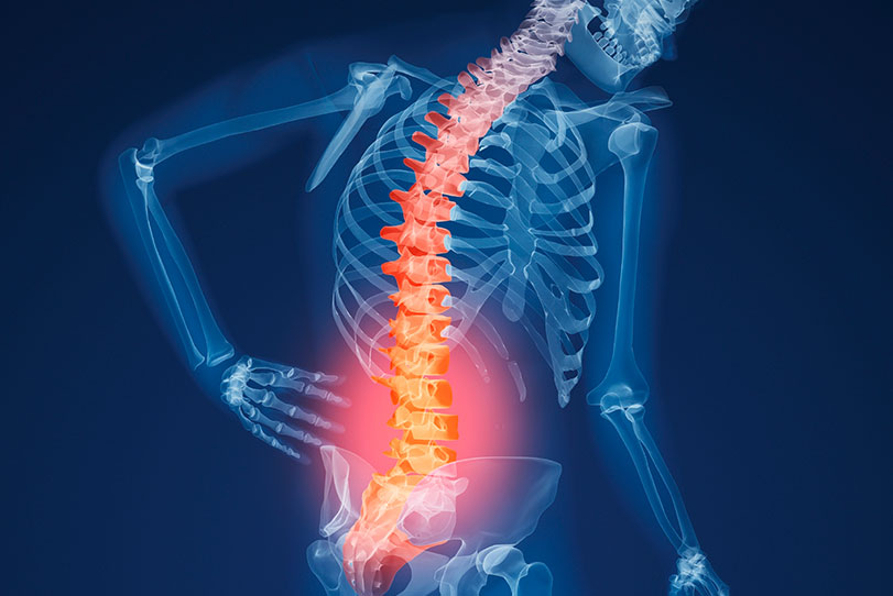 Osteoporose - Ossos frágeis: sinal de alerta mesmo nos jovens