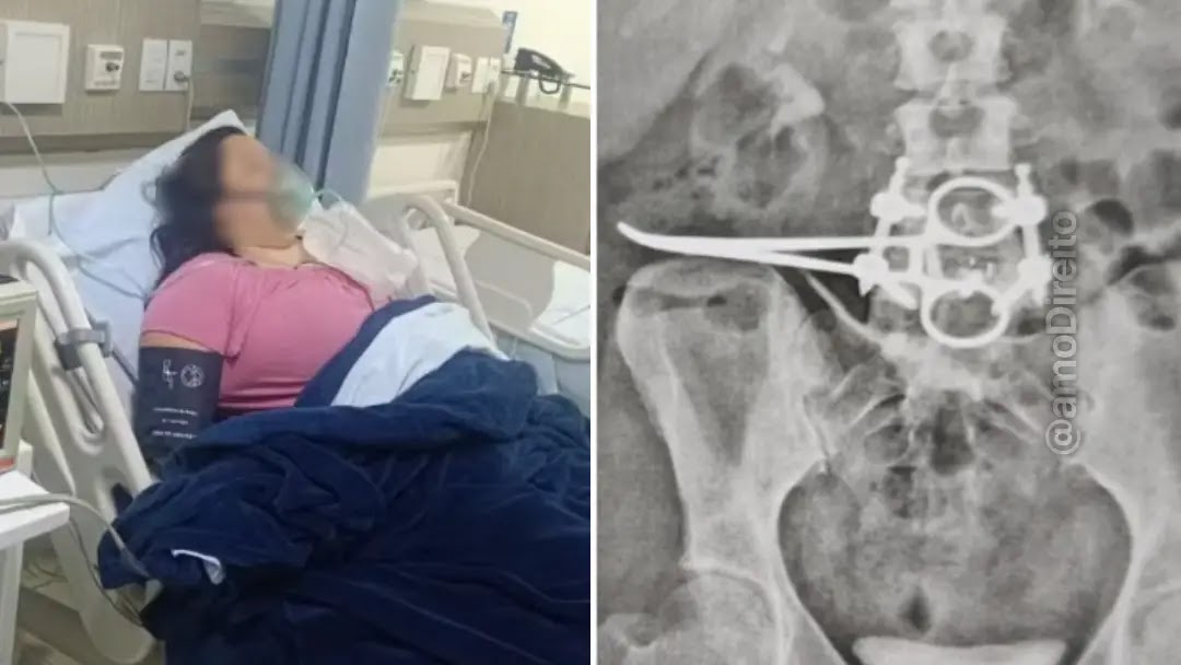 Mulher descobre pinça cirúrgica de 18 centímetros esquecida no corpo três meses após retirada do útero