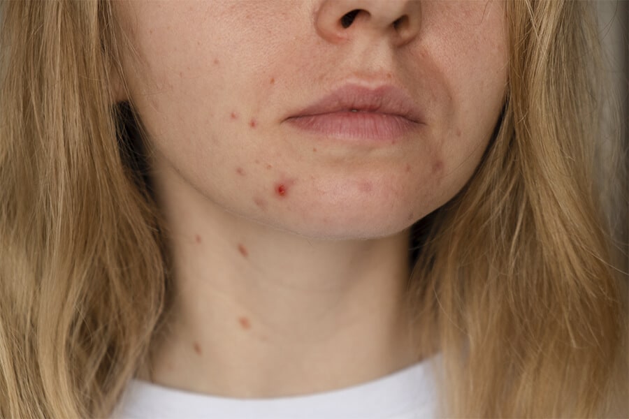 Acne depois dos 30? Entenda o que está por trás da acne da mulher adulta