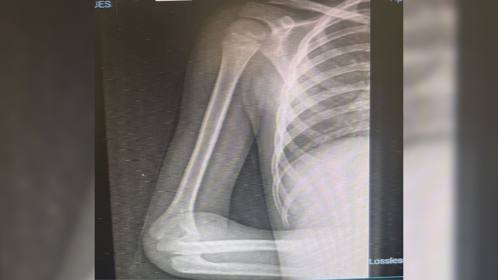Menino de 6 anos descobre câncer raro após fortes d0res no braço: 'Achei que fosse desculpa para não fazer tarefa', diz mãe
