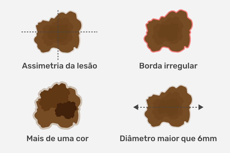 Qual a diferença de um simples sinal para um câncer de pele? Fique atento