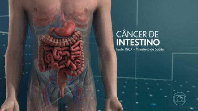 Câncer de intestino: Descubra os sintomas silenciosos que merecem atenção