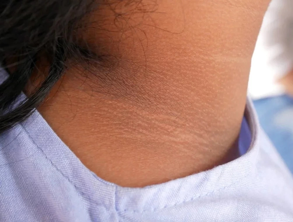 Diabetes pode dar sinais na pele, nos olhos e até nos pés; confira quais são
