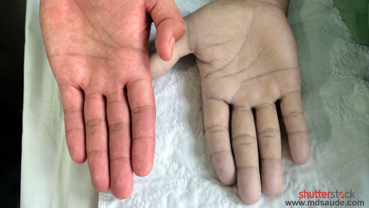 Atenção para 12 sintomas que você pode está com anemia e nem desconfiar