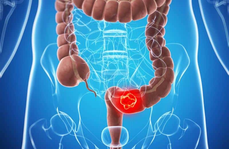 Quais os primeiros sinais de câncer no intestino que tem atingido cada vez mais pessoas jovens