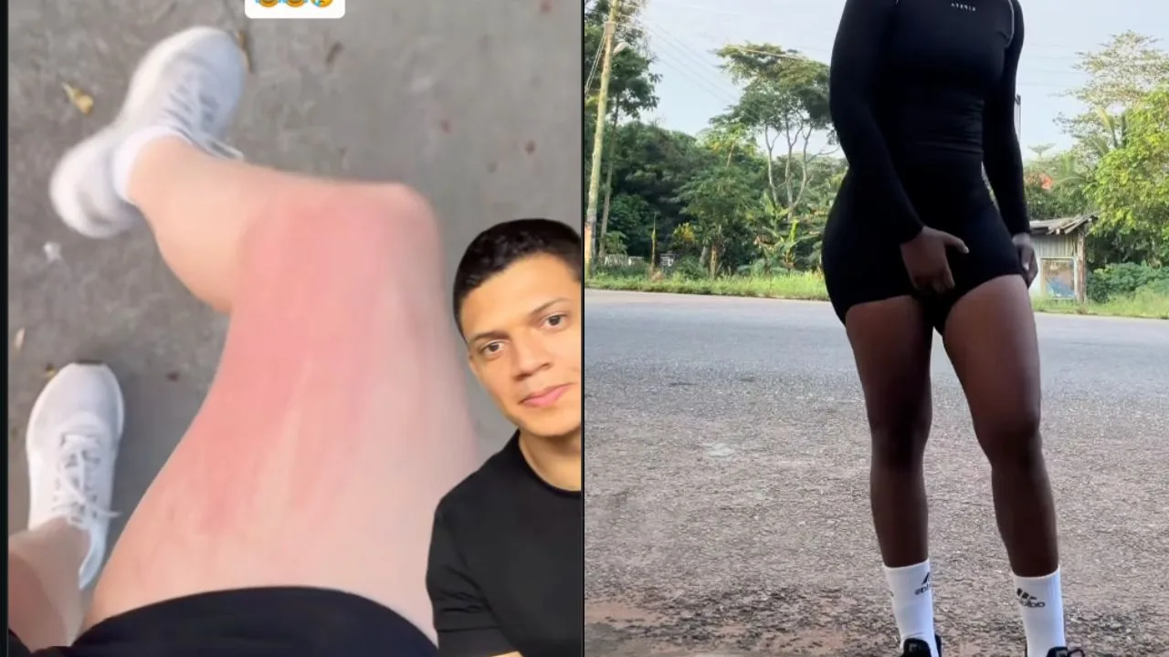 Por que algumas pessoas ficam vermelhas e sentem coceira durante caminhada ou corrida, segundo médico