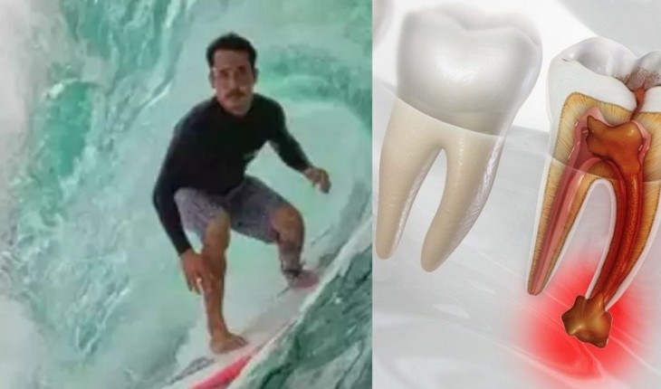 Surfista Brasileiro Em Coma Especialista Explica Como Uma Infec O No Dente Pode Acabar Levando